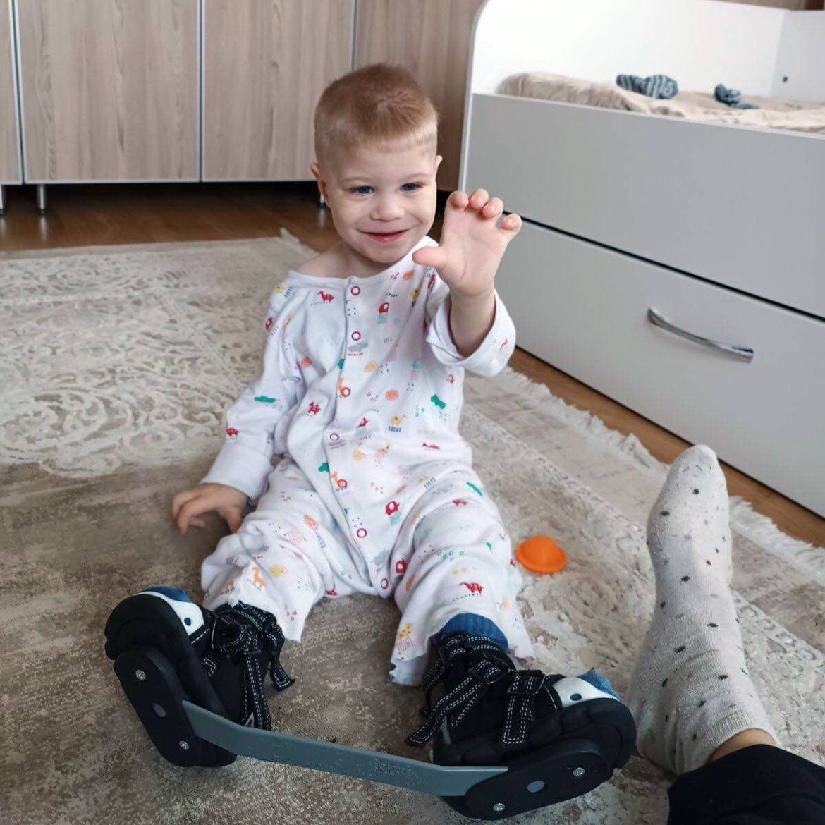 Ukraine child with clubfoot in the Iowa Brace