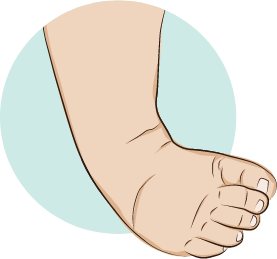 Understanding Clubfoot Deformity