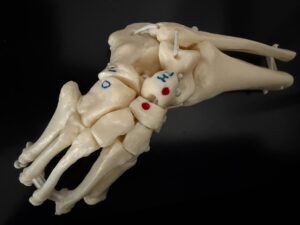 Vertical Talus Model